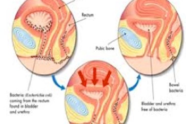 Viêm đường tiết niệu - nỗi khổ sở của phụ nữ sau sinh