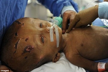 Cứu sống bé gái đầu phình to bất thường