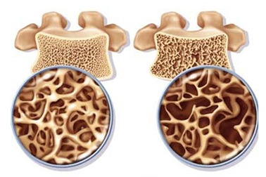 Loãng xương và những dấu hiệu khó ngờ
