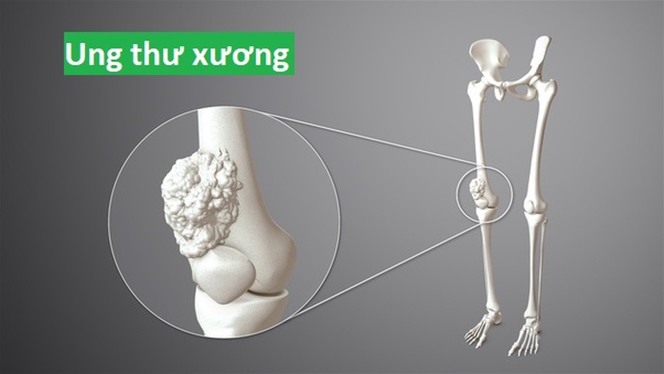 Thường xuyên nhức đầu gối về đêm, nam sinh bất ngờ phát hiện ung thư xương - 2 Thường xuyên nhức đầu gối về đêm, nam sinh bất ngờ phát hiện ung thư xương - 2