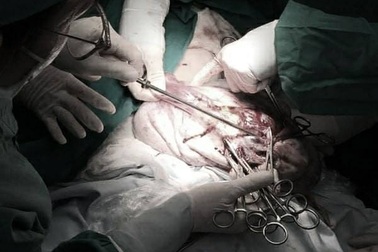 Giải thoát bé gái khỏi khối u buồng trứng khổng lồ