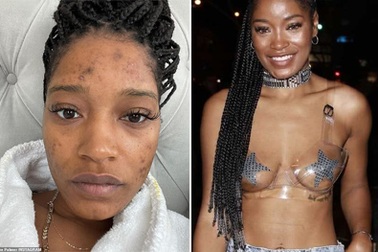 "Sao" Hollywood "lộ" mặt toàn mụn, tiết lộ bị buồng trứng đa nang