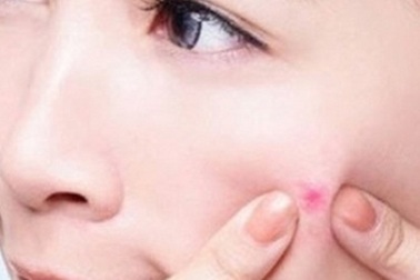 Nặn mụn thế nào cho an toàn?