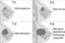 Phân biệt u vú lành tính và ung thư vú