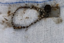 Nuốt nam châm, bé trai 6 tuổi bị thủng ruột