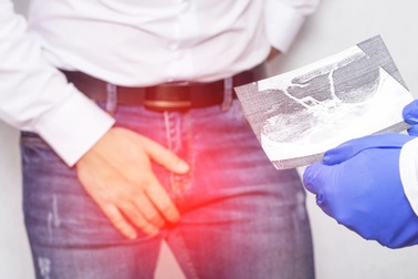 Nang vùng kín gây vô sinh ở nam giới: Sự thật thế nào?