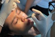 TPHCM: Mất 300 triệu đồng đổi lấy 6 lần sửa mũi đau đớn và bộ mặt biến dạng