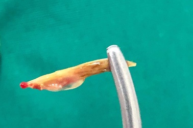 Tưởng mắc bệnh trĩ, ai ngờ bị xương cá đâm thủng ống hậu môn