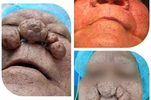 Kỳ lạ người đàn ông có “mũi sư tử”