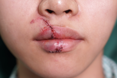 Đùa giỡn quá trớn với cún cưng, cô gái 18 tuổi ở TPHCM bị cắn rách môi