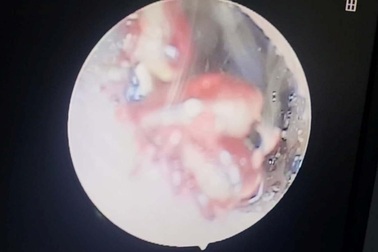 Gắp 4 con ve chó trong tai bé gái 10 tuổi