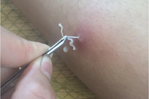 Giun rồng dài hàng mét "đục lỗ" chui ra khỏi cơ thể