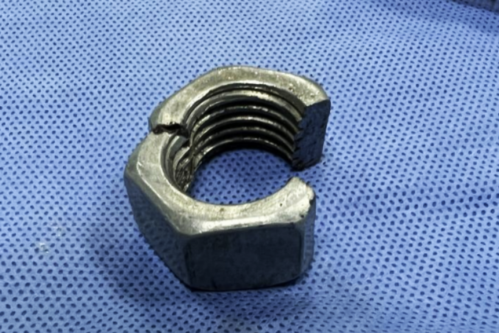Dùng máy cắt cấp cứu người đàn ông gắn đai ốc vào của quý để kích thích - 1 Dùng máy cắt cấp cứu người đàn ông gắn đai ốc vào của quý để kích thích - 1