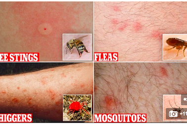 Cách phân biệt các loại vết đốt của côn trùng