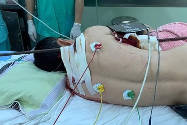Ngã giàn giáo xuống đất, nam thanh niên bị thanh sắt đâm xuyên ngực