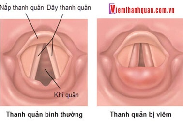 4 mẹo dân gian chữa khản tiếng dễ dàng!