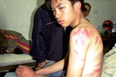 Một học sinh lớp 9 bị thầy giáo đánh nhập viện