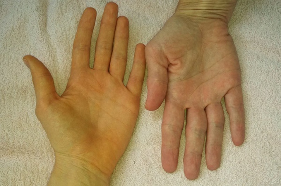 6 dấu hiệu tiền ung thư gan bạn nên để ý, đừng để cái chết đến gần - 3 6 dấu hiệu tiền ung thư gan bạn nên để ý, đừng để cái chết đến gần - 3