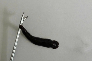 Con đỉa lớn nằm trong mũi bé trai 14 tuổi