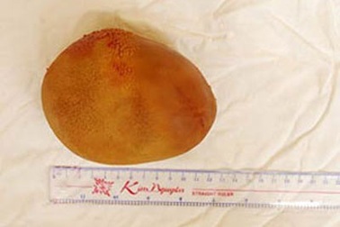 Viên sỏi bàng quang nặng 0,8kg