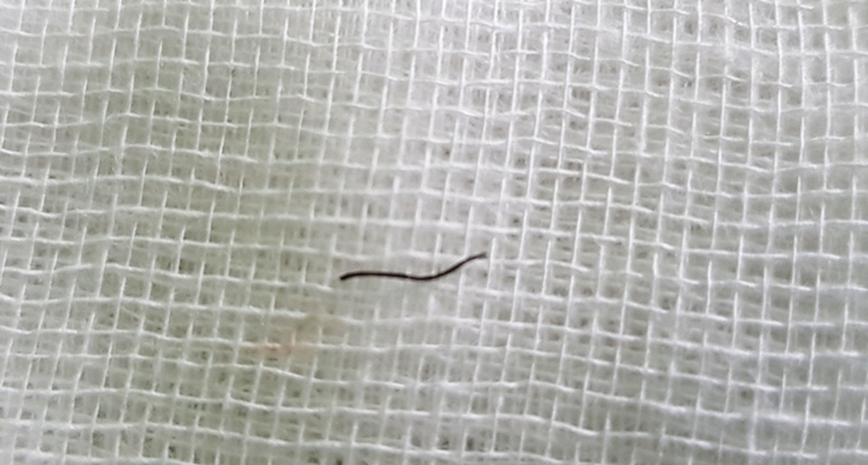 Người đàn ông 46 tuổi bị mảnh sắt đâm xuyên giác mạc - 1 Người đàn ông 46 tuổi bị mảnh sắt đâm xuyên giác mạc - 1