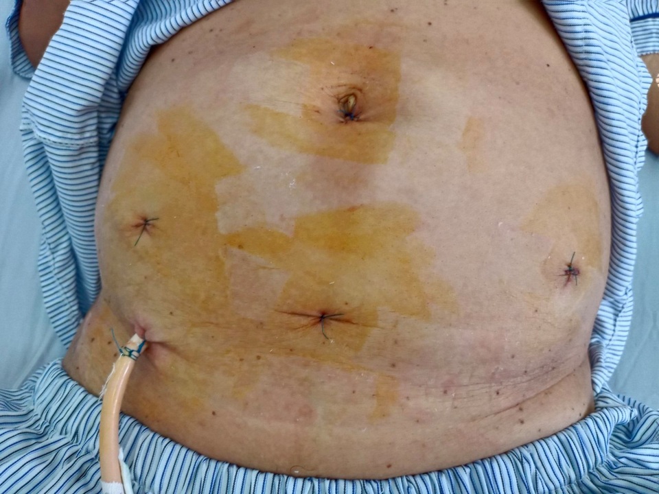 Đã mãn kinh đột nhiên xuất huyết âm đạo coi chừng ung thư - 2