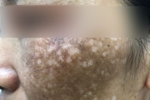 Mặt loang lổ sẹo sau khi chi gần 500 triệu đồng chữa rám má ở spa