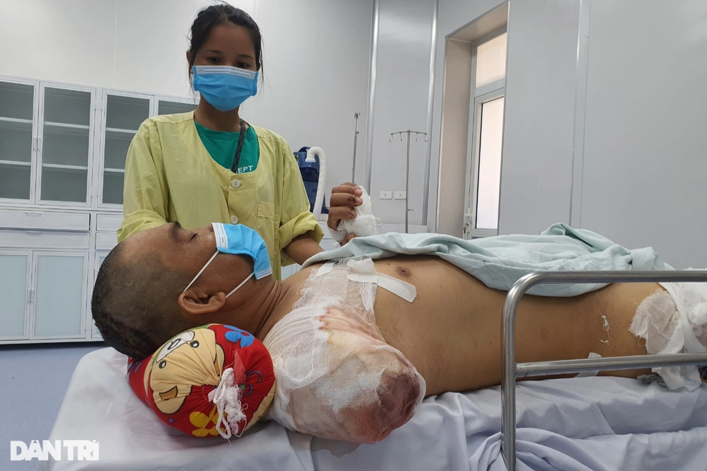 Bỏng điện cao thế, người đàn ông trụ cột gia đình phải cắt cụt tay, chân - 4