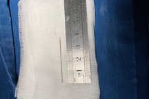 Gắp thành công kim đâm xuyên thành ngực cứu bệnh nhi 3 tuổi