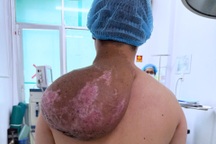 Chàng trai biến dạng cơ thể, 5 năm mang "tảng đá" trên vai vì căn bệnh hiếm