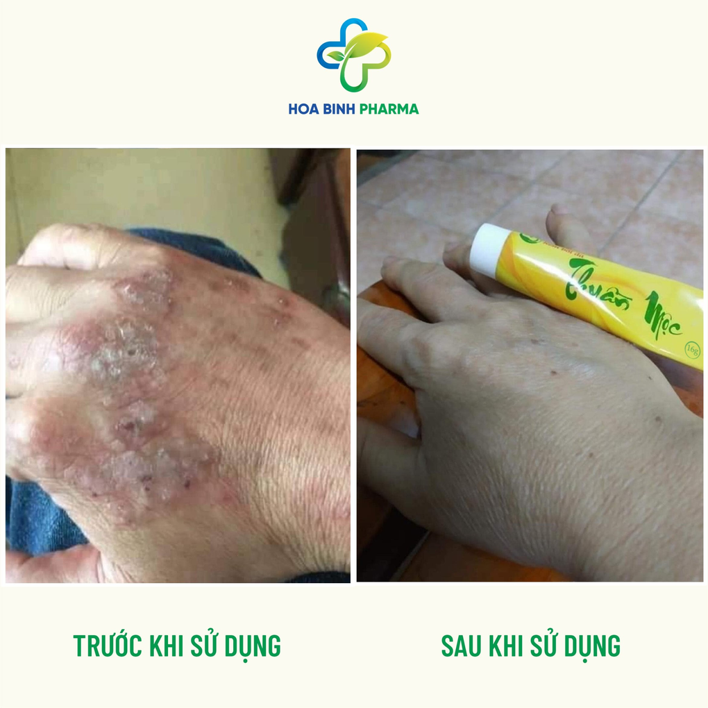 Công thức đột phá của kem bôi da Thuần Mộc - 1 Công thức đột phá của kem bôi da Thuần Mộc - 1