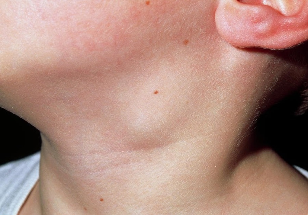 Người phụ nữ mắc bệnh Sarcoidosis vùng cổ hiếm gặp - 1 Người phụ nữ mắc bệnh Sarcoidosis vùng cổ hiếm gặp - 1