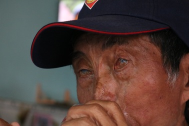 Người đàn ông bị nhân tình của vợ tạt axit thẳng mặt