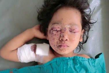 Bé gái hỏng cả hai mắt do dẫm phải thuốc nổ