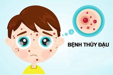 Hỗ trợ cải thiện triệu chứng thủy đậu nhờ gel Subạc