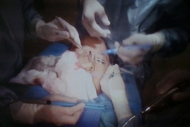 Phẫu thuật u quái giải cứu khuôn mặt cô gái trẻ