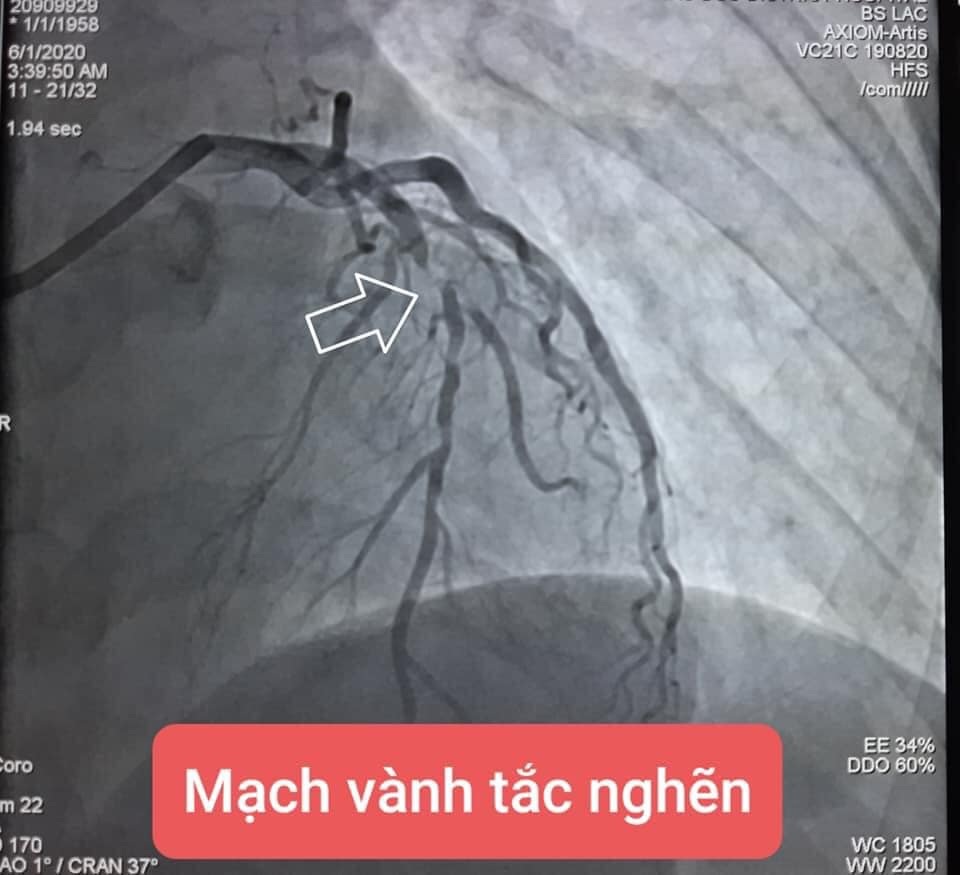 Tự dừng thuốc vì sợ khám dính Covid-19, bệnh nhân suýt chết vì đau ngực - 1 Tự dừng thuốc vì sợ khám dính Covid-19, bệnh nhân suýt chết vì đau ngực - 1