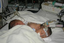 Hai bé gái sinh đôi dính ngực nằm ngược đầu nhau