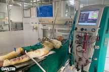 Chàng trai trẻ bốc cháy như ngọn đuốc, bỏng 71% cơ thể