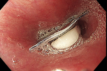 Cô gái ở TPHCM suýt chết vì lý do bất ngờ khi uống thuốc hạ sốt