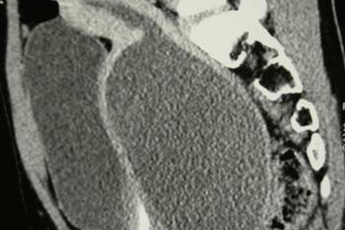 Tạo hình âm đạo cho bệnh nhi 13 tuổi