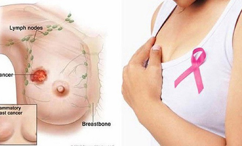 Tất cả những điều bạn cần biết để ngừa ung thư vú - 1 Tất cả những điều bạn cần biết để ngừa ung thư vú - 1