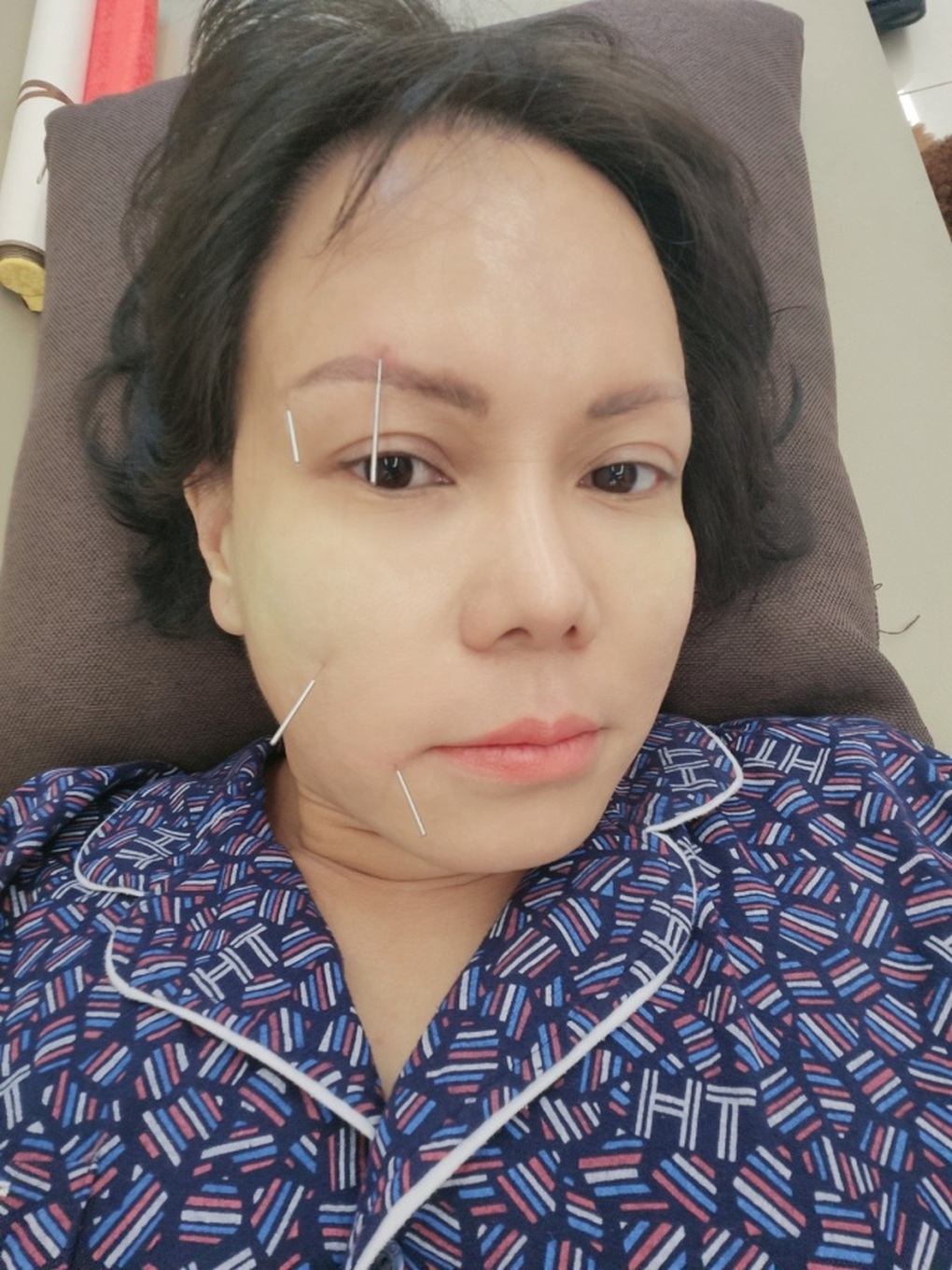 Việt Hương bị lệch mặt, phải châm cứu toàn thân bằng 50 cây kim - 1 Việt Hương bị lệch mặt, phải châm cứu toàn thân bằng 50 cây kim - 1