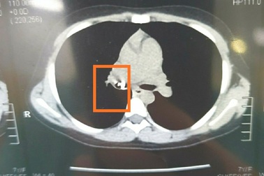 Bé gái đau ngực suốt 2 tháng sau khi được mẹ nhổ răng hàm