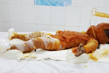 3 chị em đốt rác gây cháy nhà, một bé gái bị bỏng nặng