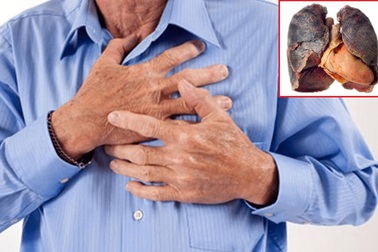 Ho ra máu tươi, cụ ông đi khám phát hiện ung thư phổi giai đoạn cuối