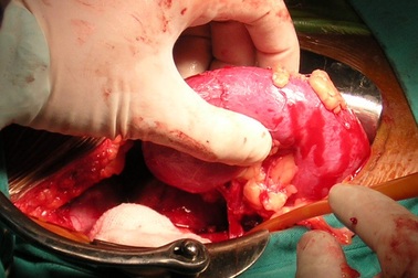 Có hay không tình trạng “cò buôn bán thận”?