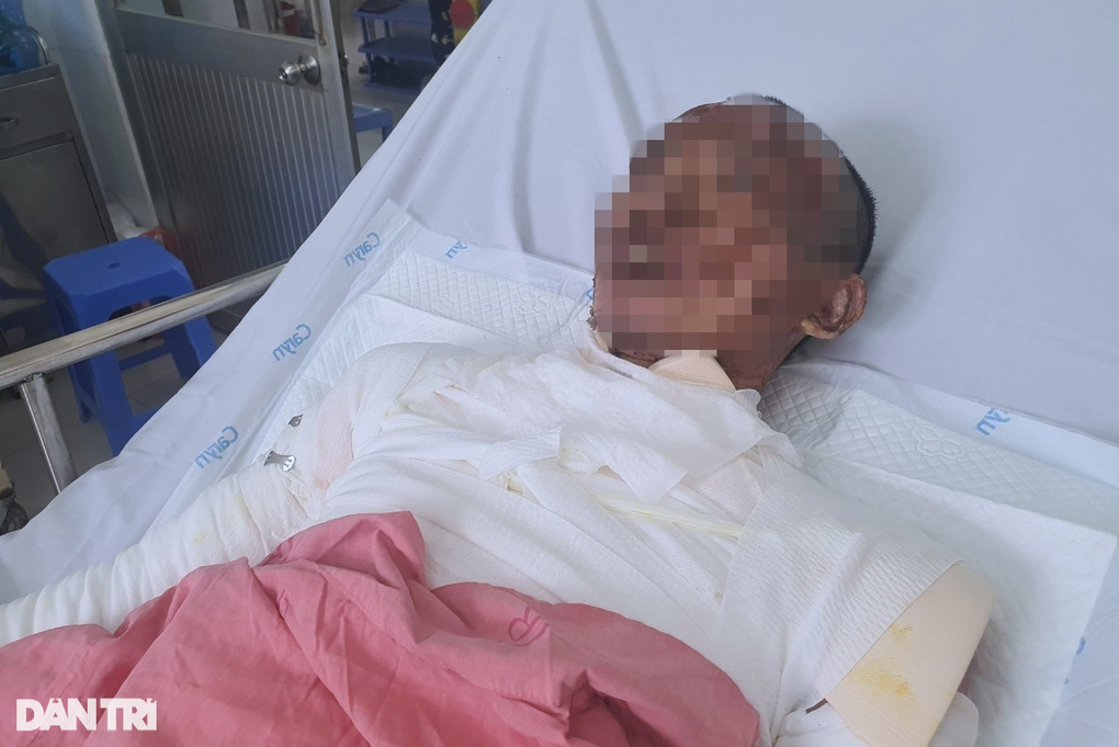 Cha dùng cồn nướng mực cho con gái ăn, 3 người trong nhà bỏng thương tâm - 1 Cha dùng cồn nướng mực cho con gái ăn, 3 người trong nhà bỏng thương tâm - 1