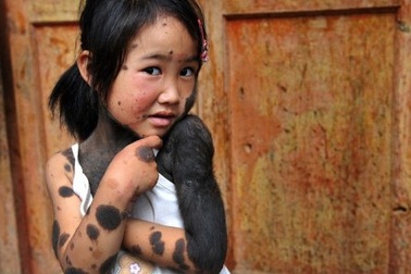 Chứng bệnh lạ khiến bé gái thành “người thú”