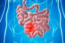 Các tác nhân dẫn đến ung thư ruột non bạn cần biết